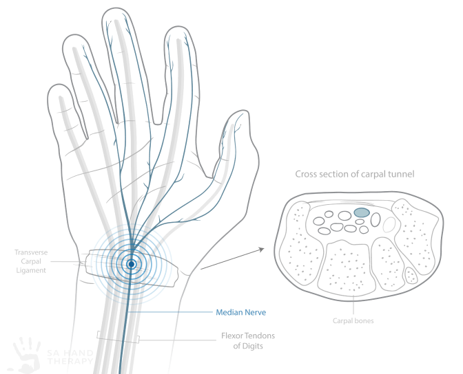 This diagram is a representation of the carpal tunnel and its contents. The cross sectional area of the diagram shows the tunnel formed by bone structure, the 9 tendons within it and the median nerve.