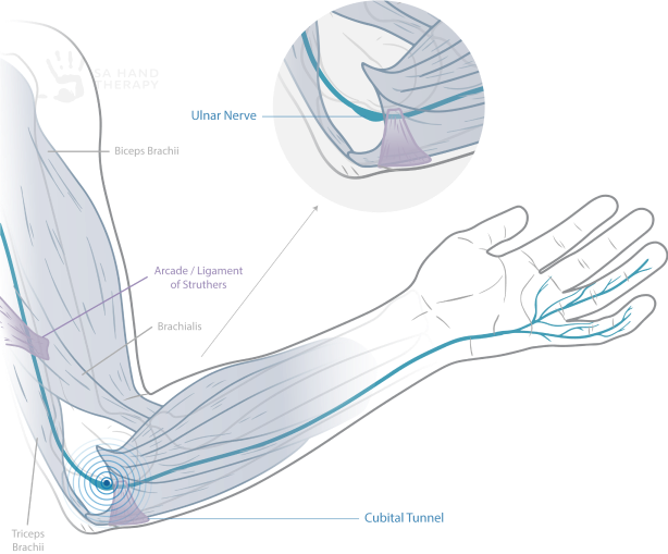 This diagram illustrates cubital tunnel syndrome and the anatomical pathway of the ulna nerve as it passes through the ligament of struthers in the distal upper arm and then the cubital tunnel at the elbow. the ulna nerve pathway extends to the little and ring fingers.