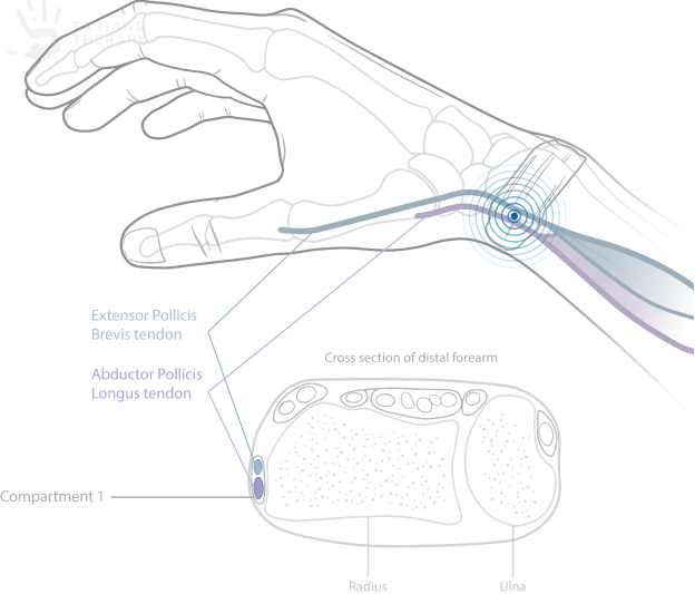 Anatomy of De Quervains tenosynovitis - The diagram displays the radial aspect of the wrist and location of the first dorsal extensor compartment with tendons extensor pollicis brevis and abductor pollicis longus. #Dequervains #Anatomy #Firstdorsalcompartment