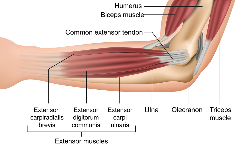 Anatomy of Tennis Elbow - The diagram displays the interior of the elbow and forearm, highlighting the extensor muscles and the common extensor tendon. Learn how tennis elbow (lateral elbow tendinopathy) occurs and affects these structures.