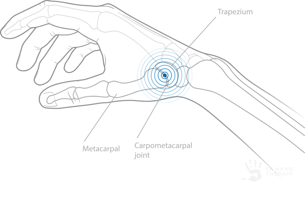This picture illustrates the location of base of thumb arthritis between the base of the 1st metacarpal bone and the trapezium bone.