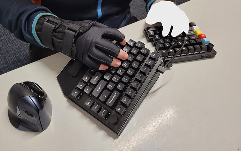 client using split keyboard and vertical mouse with their right hand supported in a splint and compression glove